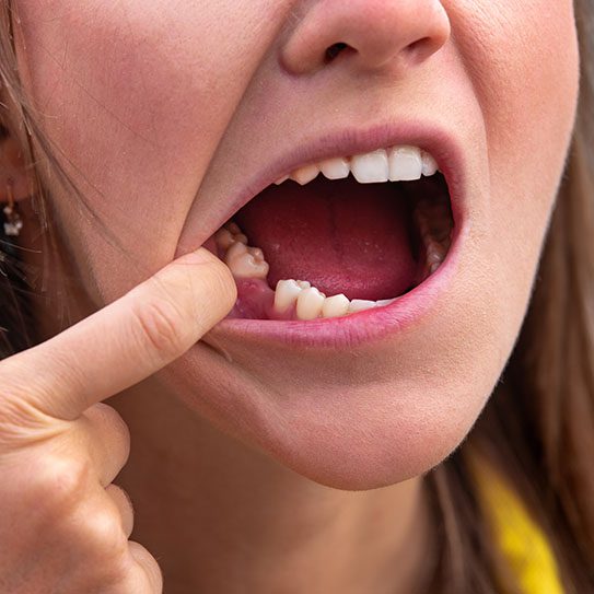Ogden dental implants